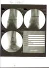 Ankle Screws.webp